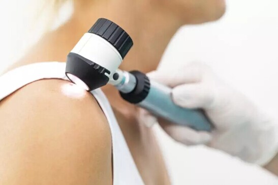 Melanoma day, una giornata nazionale per la prevenzione