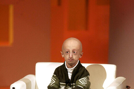 Cos'è la progeria, la malattia che brucia la giovinezza