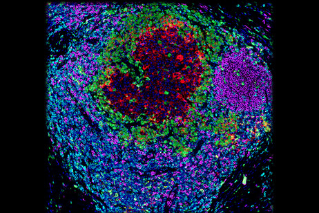 Una cellula tumorale circondata da cellule immunitarie (fonte: Romain Remark, Miriam Merad, e Sacha Gnjatic/Innate Pharma and Icahn School of Medicine at Mount Sinai)