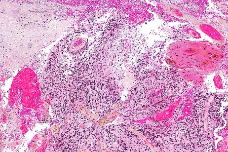 Cellule di glioblastoma (fonte: Nephron da Wikimedia CC BY-SA 3.0)