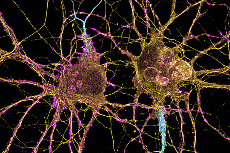 I neuroni dello striato sono i più colpiti dalla malattia di Huntington (fonte: Leterrier, NeuroCyto Lab, INP, Marsiglia)
