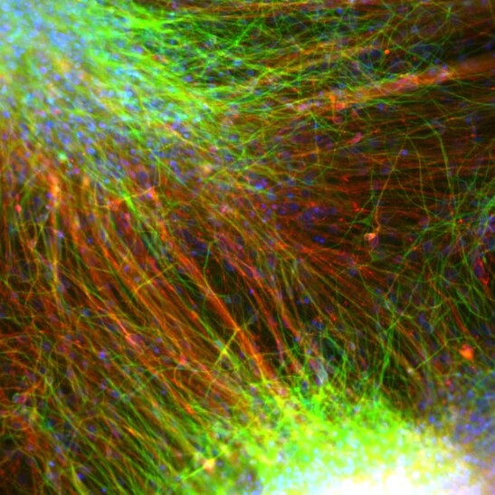 Neuroni differenziati a partire da cellule staminali embrionali impiantati in malati di Parkinson nella sperimentazione condotta in Europa (fonte: Malin Parmar Lab)