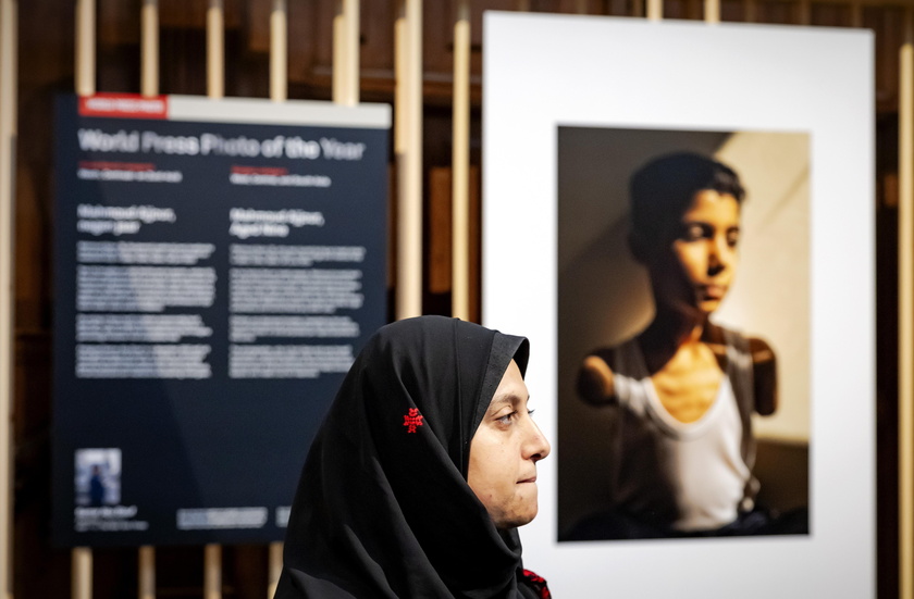 World Press Photo, bambino amputato a Gaza foto dell'anno