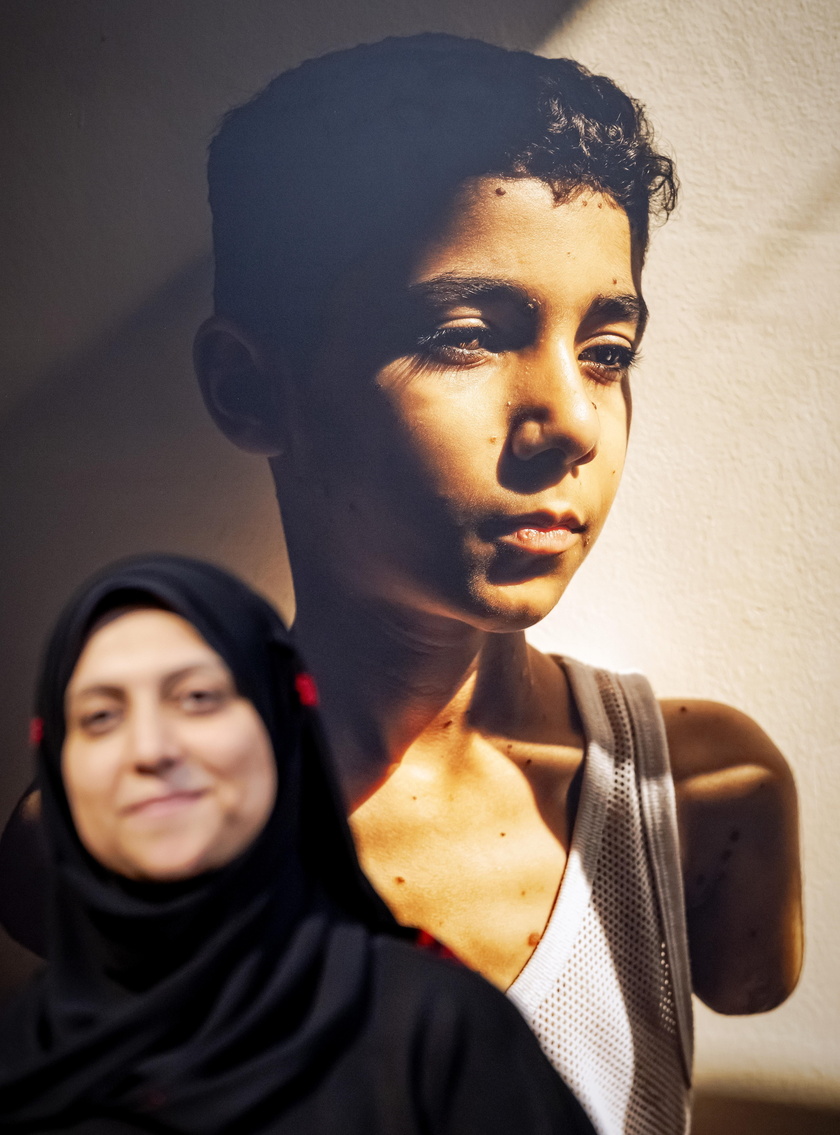 World Press Photo, bambino amputato a Gaza foto dell'anno